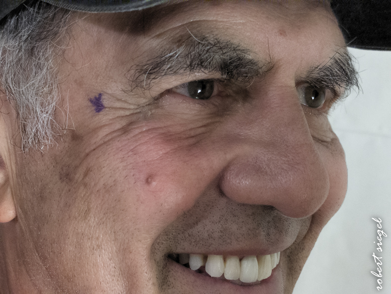 cataract surgery March 2 2026